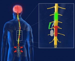 Spinal Implant for Pain