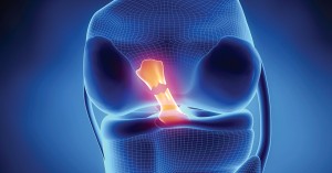 Nanotechnology for ACL Replacements