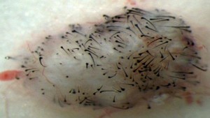 Using IPSCs to Grow New Hair