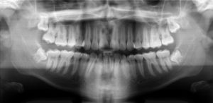 Basic Panoramic Dental X-Ray