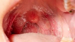 hpv in throat