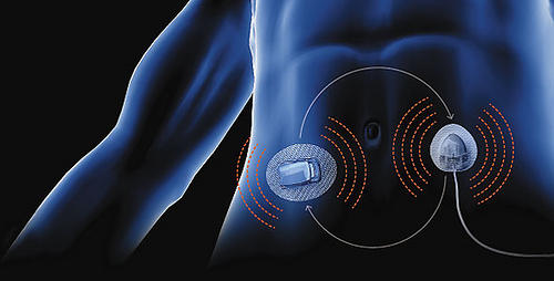 Informative Perspective on the Artificial Pancreas | Medical Automation ...